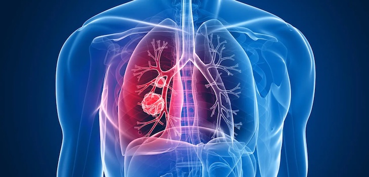 Yale Cancer Center tumore del polmone